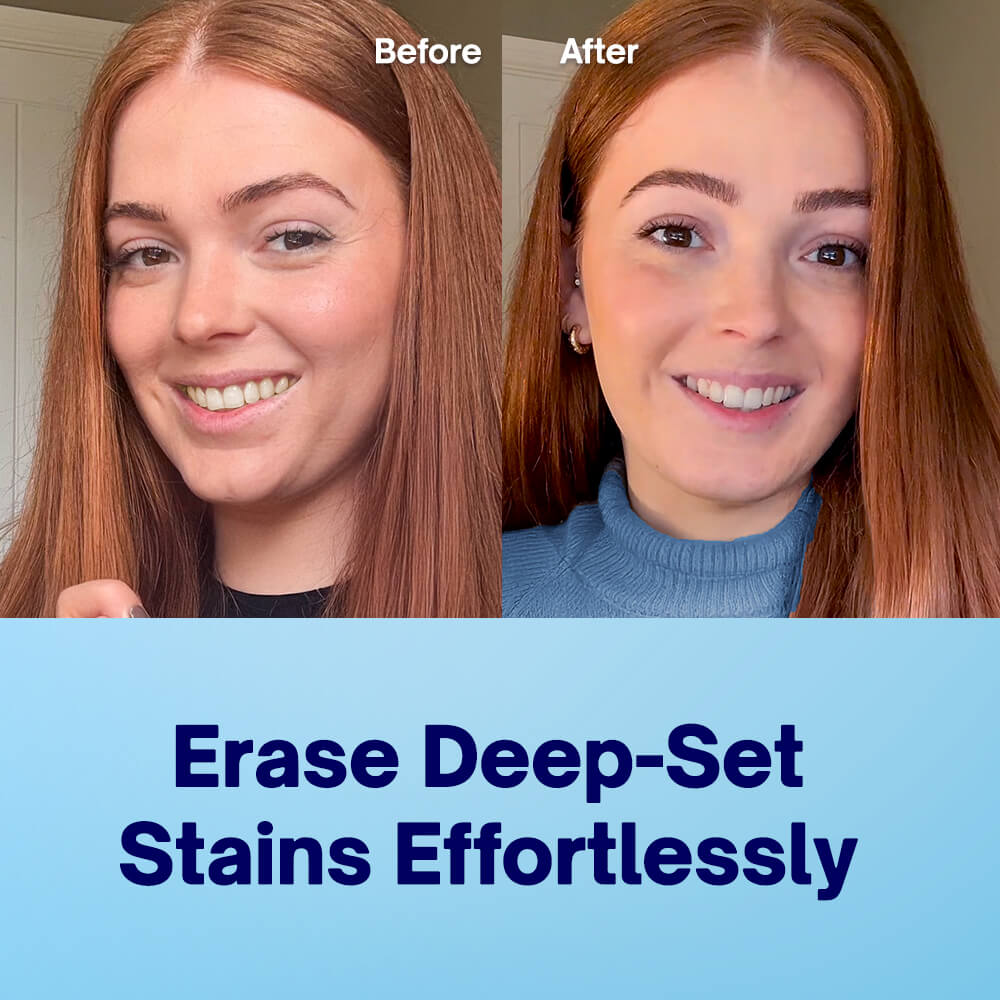 Teeth Whitening Strips