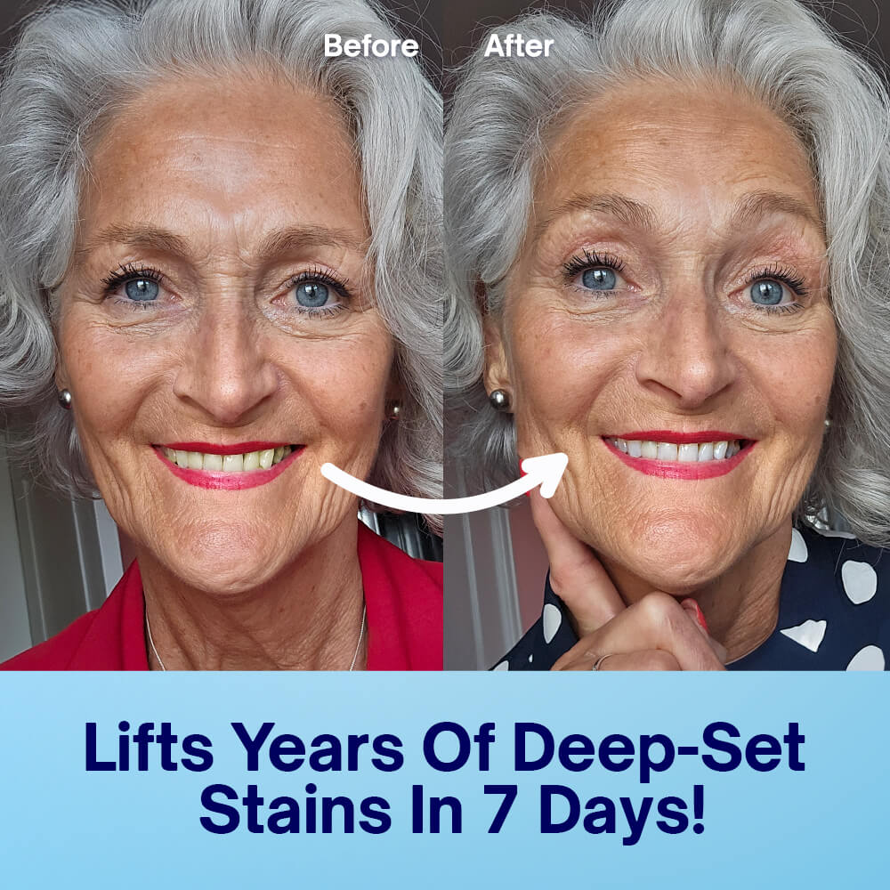 Zahnaufhellungsstreifen